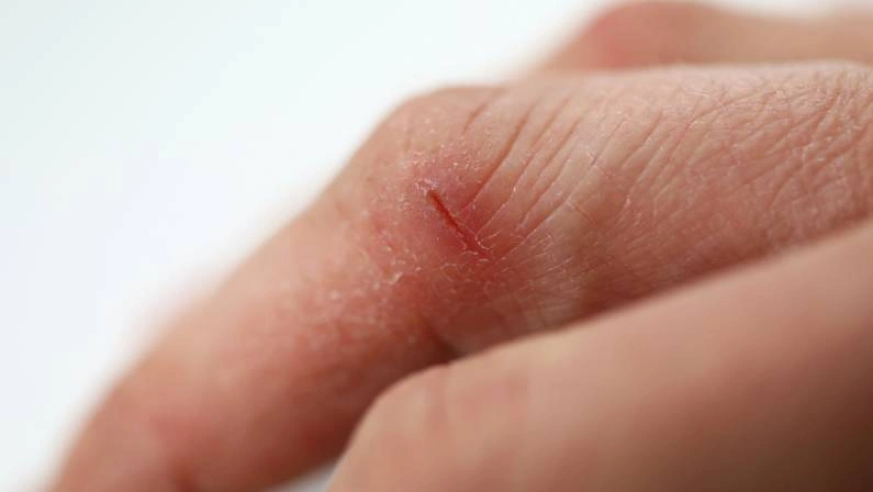 Minor Cuts and Cracks in Finger