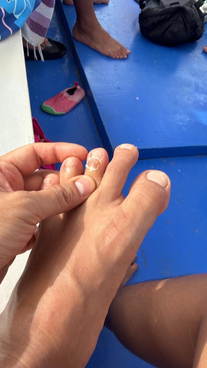 My middle toe is cracked My middle toe is cracked - Liquid Bandage for Travel: Fix Cuts & Cracked Skin Fast 🩹 - Leotrails